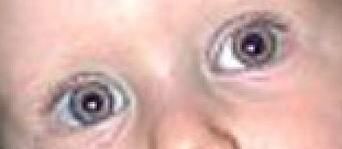 Example for the Red Eye Removal filter